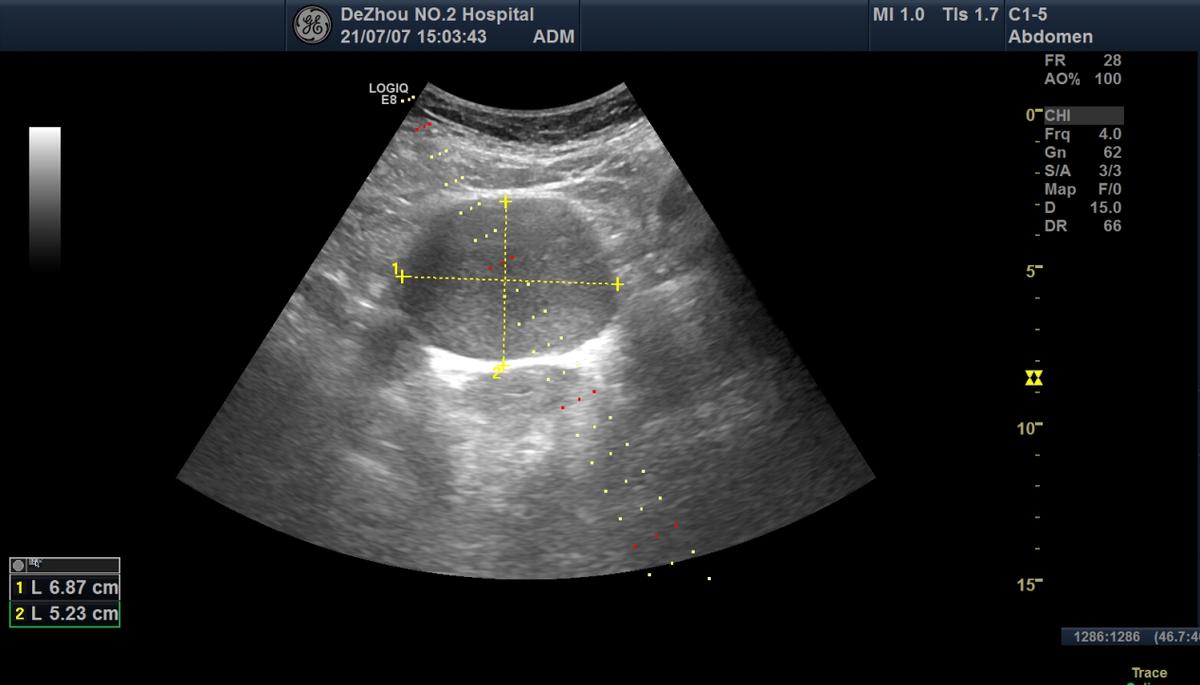 卵巢畸胎瘤和巧克力囊肿,未婚女性卵巢巧克力囊肿