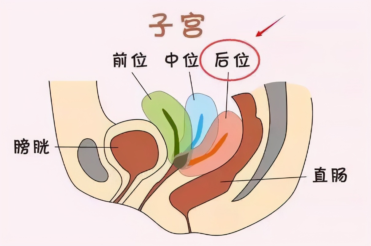 子宫后位怀孕了需要注意什么吗,子宫后位怀孕后需要注意什么