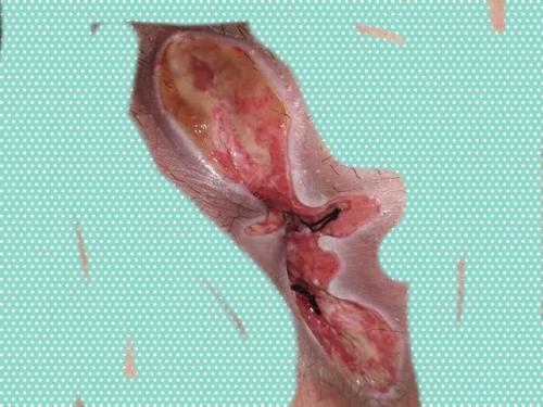 肛瘘手术比生孩子还疼吗,肛瘘手术疼痛可以承受吗