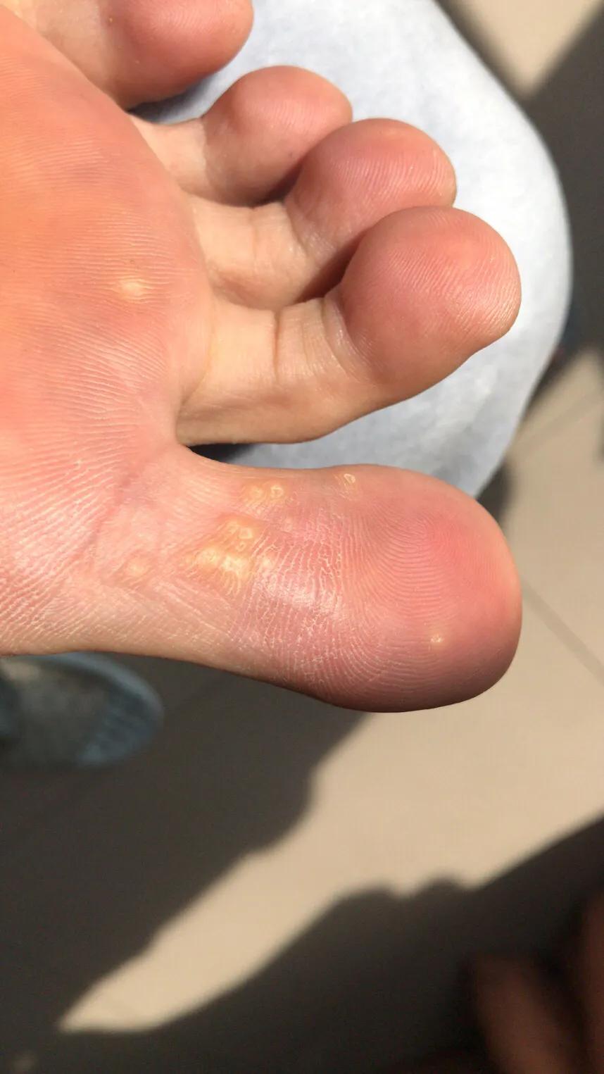 跖疣初期变化过程,跖疣详情