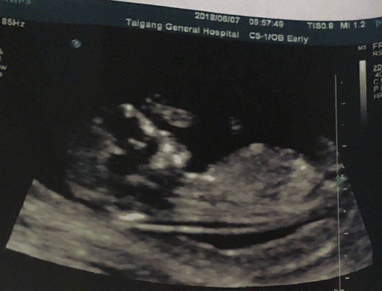 孕妈咪必须了解的自然分娩技巧,头胎孕妇顺产经历