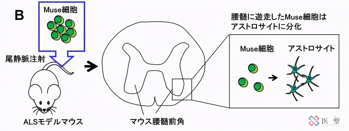 日本渐冻人症特效药 (渐冻人症细胞治疗)