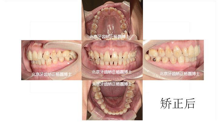 牙周病牙龈萎缩正畸案例,牙周病牙齿已经松动可以正畸吗