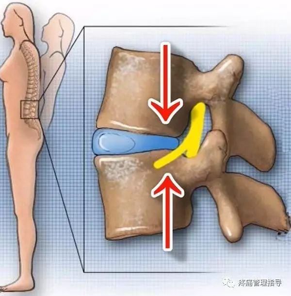 72岁老人腰疼还有骨刺该怎么治疗,老年人骨刺疼痛怎么治疗