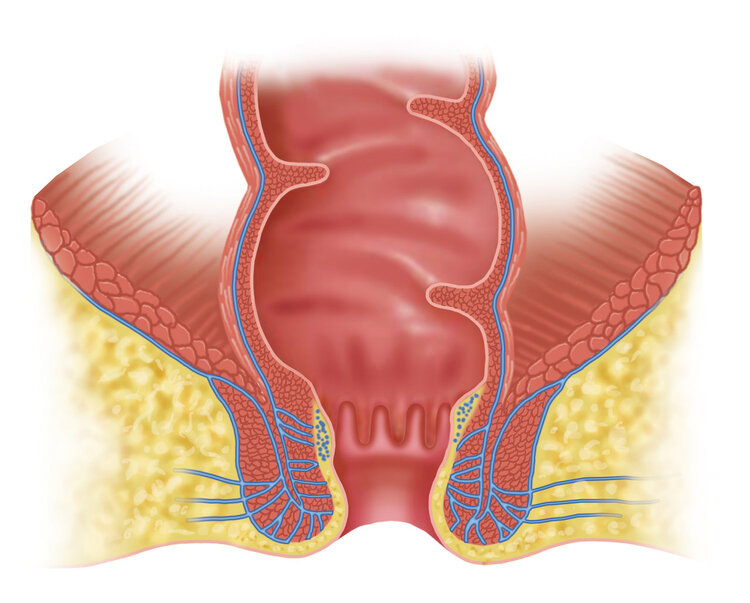 肛门有个小肉球是痔疮吗怎么治疗,痔疮肉球把肛门都堵住了怎么治疗