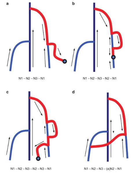 chiva治疗下肢静脉曲张价格,chiva治疗静脉曲张