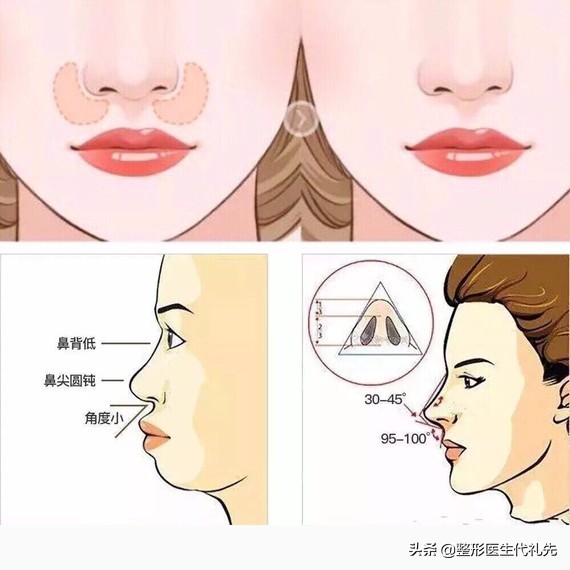 从整形医生的角度来聊一聊形成法令纹的原因以及改善方案