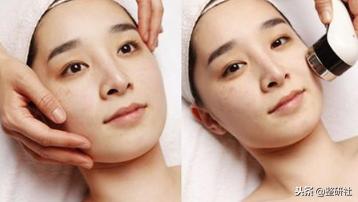 选择光电祛斑，出门再也不担心颜值掉线