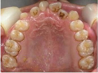 儿童一颗恒牙长一半很久不长了,19岁乳牙不掉不长恒牙的危害