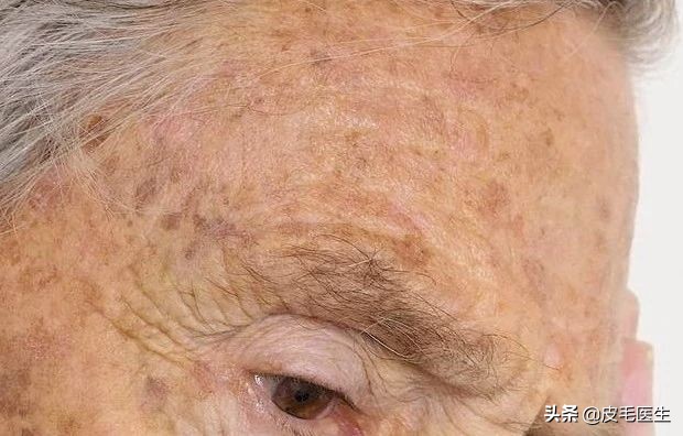 雀斑黄褐斑老年斑祛斑方法,褐斑老年斑怎么治疗效果最好