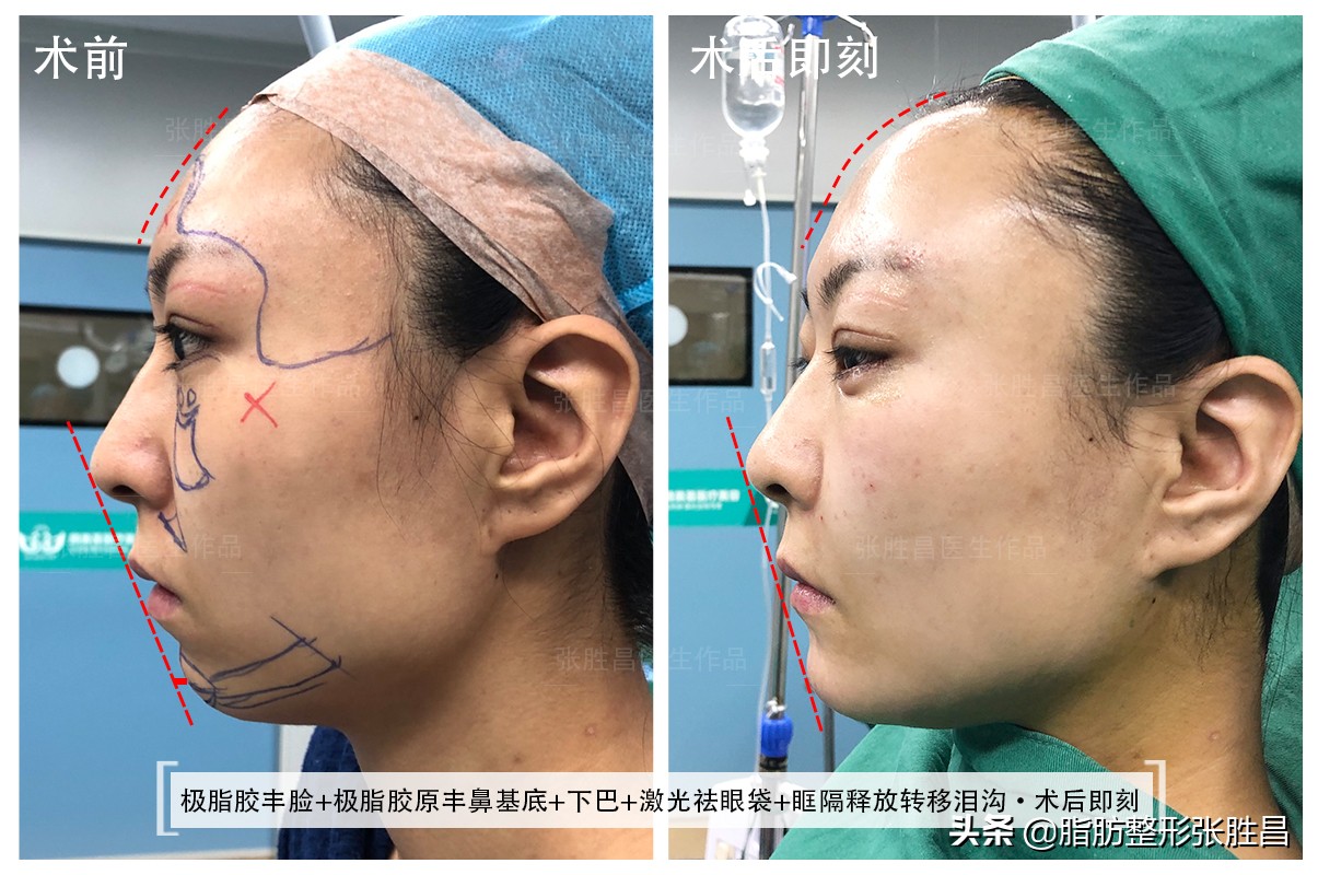 做完假体还能填脂肪吗,做完假体下巴还能打玻尿酸吗