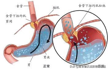 咽喉异物感声音嘶哑刺激咳嗽,咽部有异物感声音嘶哑