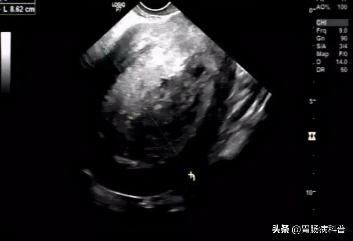 70岁老太，长出粗黑腿毛，医生说，这可能是癌的征兆