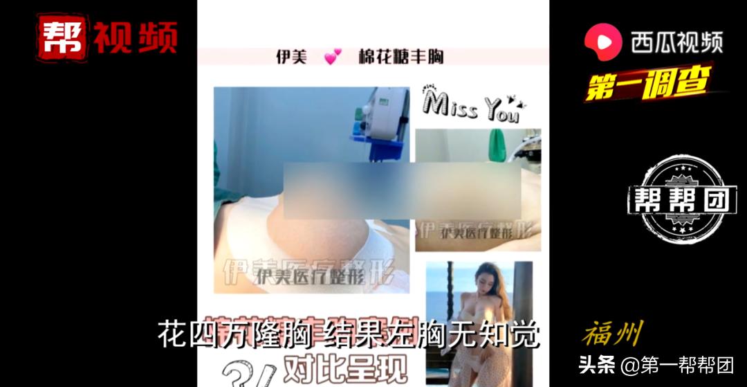 隆胸遭受的惨痛代价,女子隆胸失败左胸毫无知觉