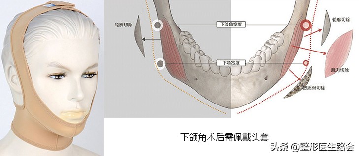 方脸国字脸下颌缘提升,方脸国字脸下颌骨宽