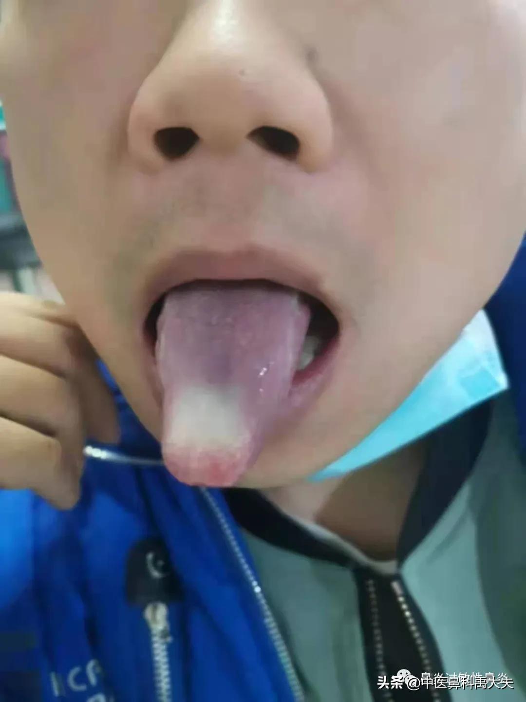 血管运动性鼻炎和过敏性鼻炎症状,鼻炎和过敏性鼻炎症状区别