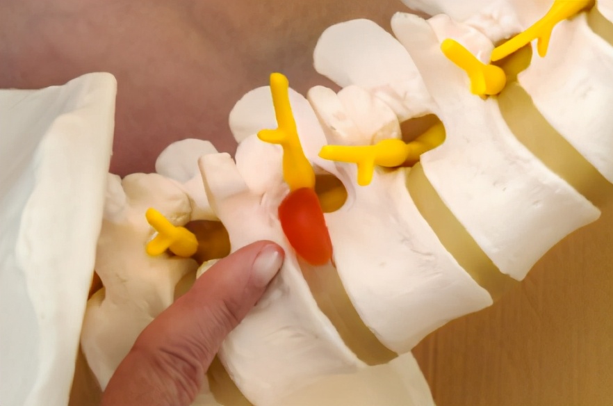 腰椎间盘突出膨出怎样锻炼恢复,颈椎腰椎间盘突出锻炼最好方法