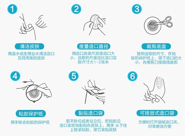 中国100万造口人：改道的肠子，改变的人生