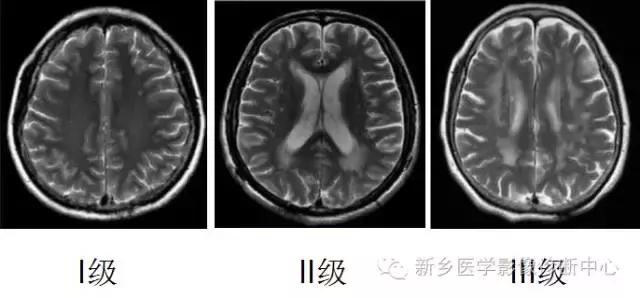 大脑深部白质区见斑点状异常信号,脑白质病变建议mri检查是什么意思