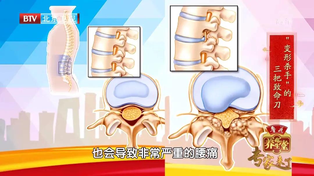 腰椎其中一节变形最好的治疗方法,腰椎轻度变形怎么治