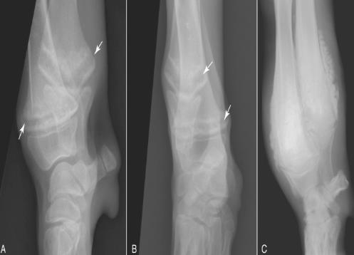 肥大性肌营养不良的症状表现,肥大性肌营养不良怎么办