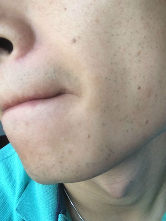 九岁男孩骨龄11岁家长粗心没发现,10岁男孩长胡须1米4