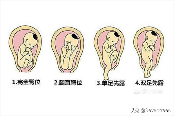 怀孕臀位宝宝的腿怎样矫正呢,臀位多喝水能转正胎位吗