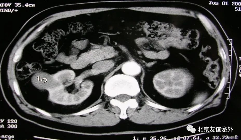 体检发现肾囊肿了怎么办?