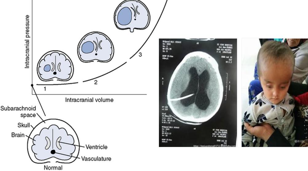 儿童反复呕吐是周期性呕吐吗?*013院医**邹丽萍教授解读儿童呕吐
