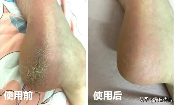 爽炸了!干丑裂的脚皮,一张完整撕掉,敢跟婴儿比姣嫩!