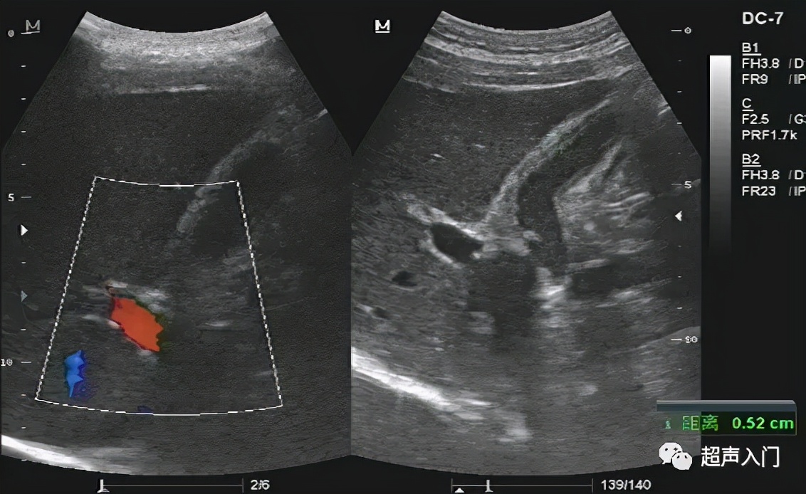 急性胆囊炎超声表现入门教学视频,急性胆囊炎超声诊断怎么写