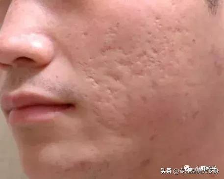 祛痘印最好的方法目前最有效的,祛痘印有效的精华