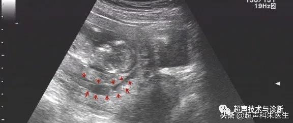 绒毛膜下血肿的超声图像,绒毛膜下血肿一般有啥症状