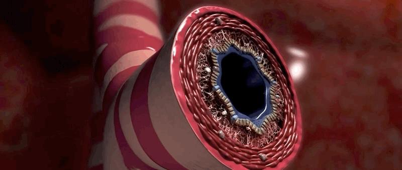 哮喘的发病原理,哮喘科普文章作品简介