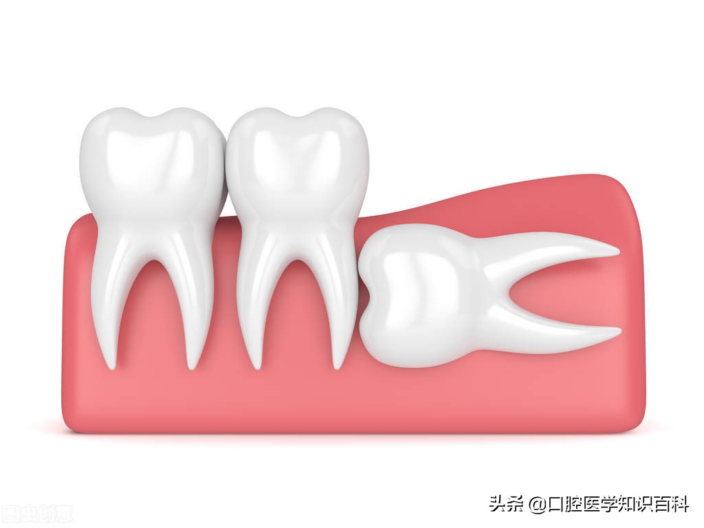 拔掉智齿和第二磨牙怎样修复,智齿拔除后的注意事项和禁忌