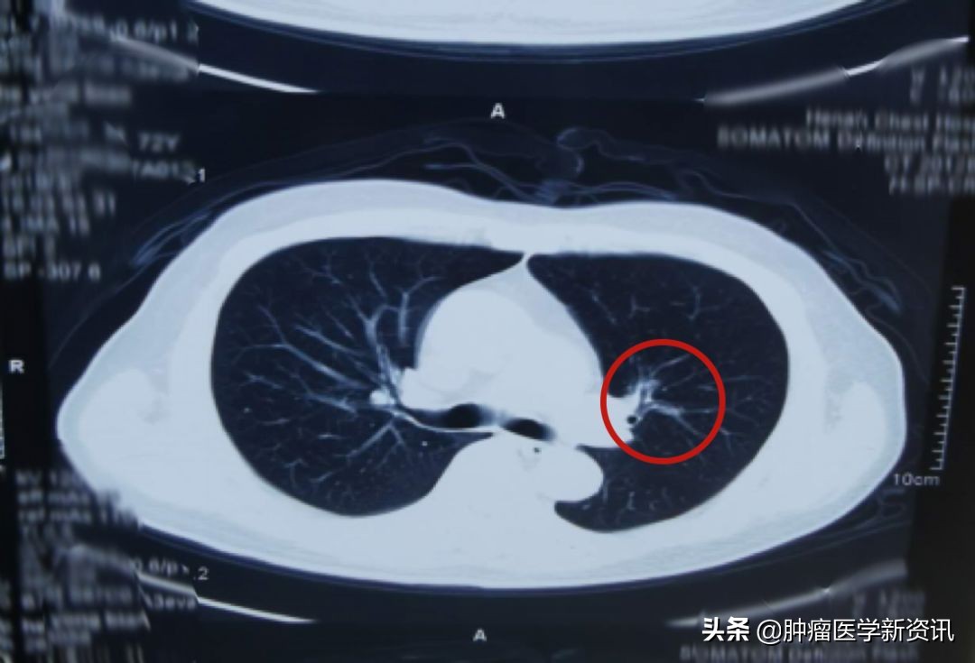 肺癌早期的6个信号中医治癌,肺癌正确的抗癌方法