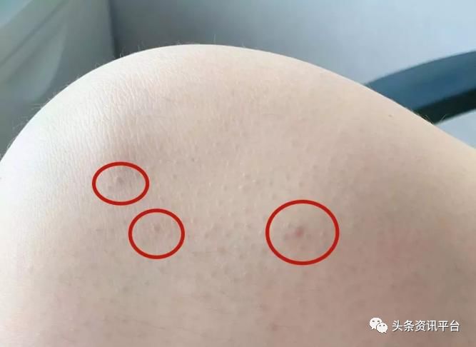 千谷生物,千谷溶脂线是怎么样的产品