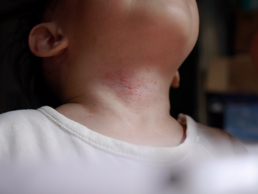 宝宝身上痱子痒怎么解决,宝宝身上长痱子可以擦爽身粉吗