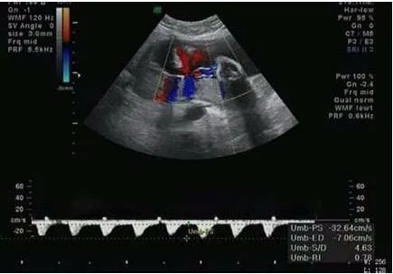 孕妇产检脐血流是什么,产检脐血流是什么