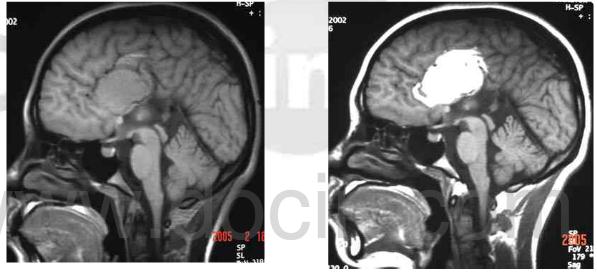 脂肪瘤是真的么,颅内长脂肪瘤伴有了癫痫怎么办
