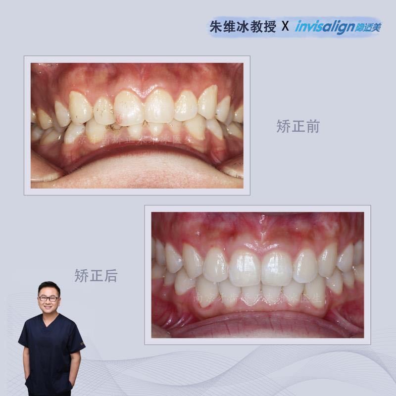 牙齿重度拥挤不拔牙正畸成功案例,南京牙齿矫正舌侧