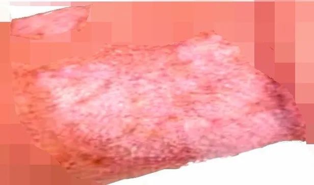 男性炎症性尿道狭窄,皮肤苔藓硬化致尿道口狭窄