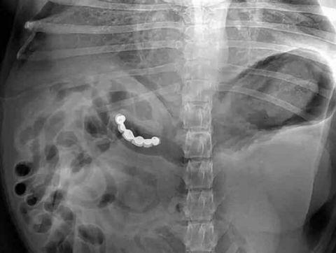 不作死就不会死，看看这些被人类搞进身体里的异物