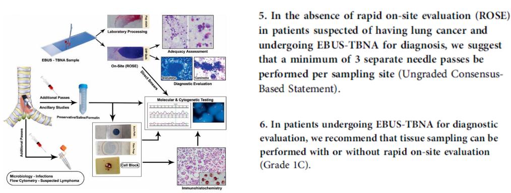 全球对肺癌治疗的最有效最新技术,肺癌的支气管镜介入治疗
