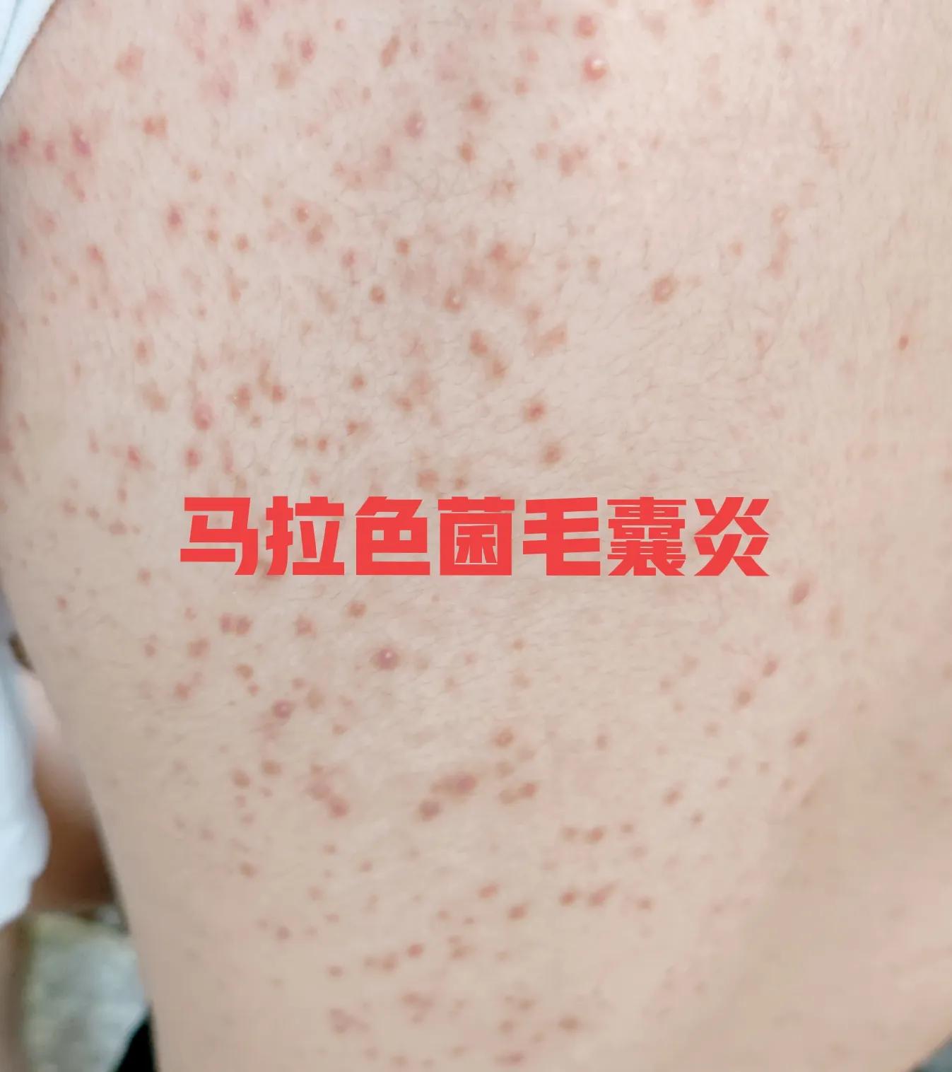 4种皮肤病最佳治疗方法,常见的手上皮肤病症状及治疗方法