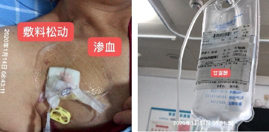 输液港不回血但输液通畅怎么办,输液港维护没有回血怎么回事