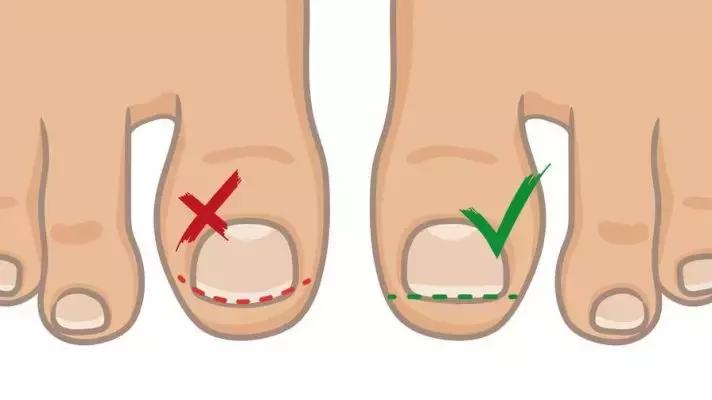 脚趾甲往肉里长怎么办很疼,脚趾甲长灰趾甲是什么情况