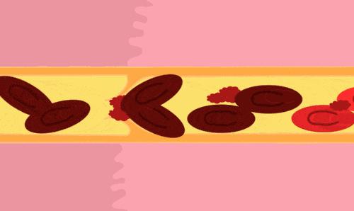 血液粘稠的症状有哪些,血液粘稠的人有什么症状