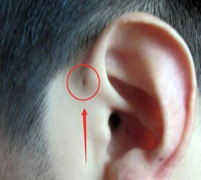为什么婴儿耳朵上有疙瘩,为什么医生说婴儿耳朵小