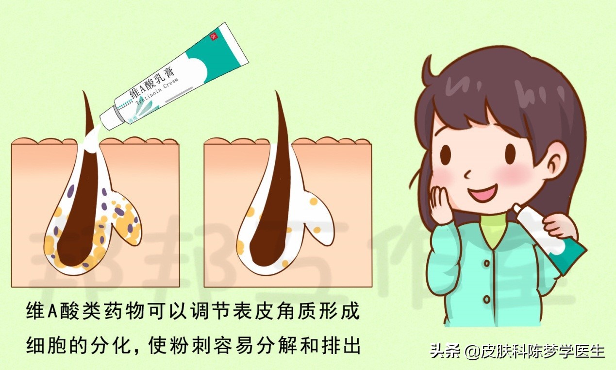 脸上爆发了严重的青春痘，这4种药物是首选